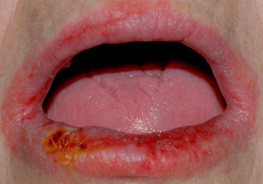唇炎反复发作会不会癌变？广州附华医院口腔黏膜专科谁去过