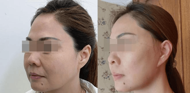 筋膜提升手术，真能让面部年轻好几岁吗？袁强博士|三件套|美容|筋膜提升