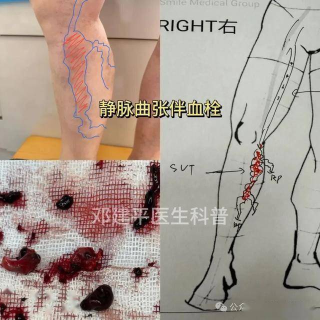 静脉曲张，会不会发展成血栓？