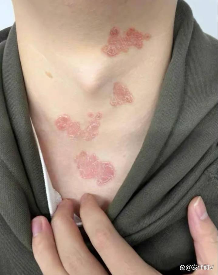 牛皮癣患者绝境逢生！有效的治疗，重获光滑皮肤