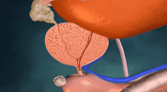 解脲支原体感染有潜伏期吗？多久会出现症状？