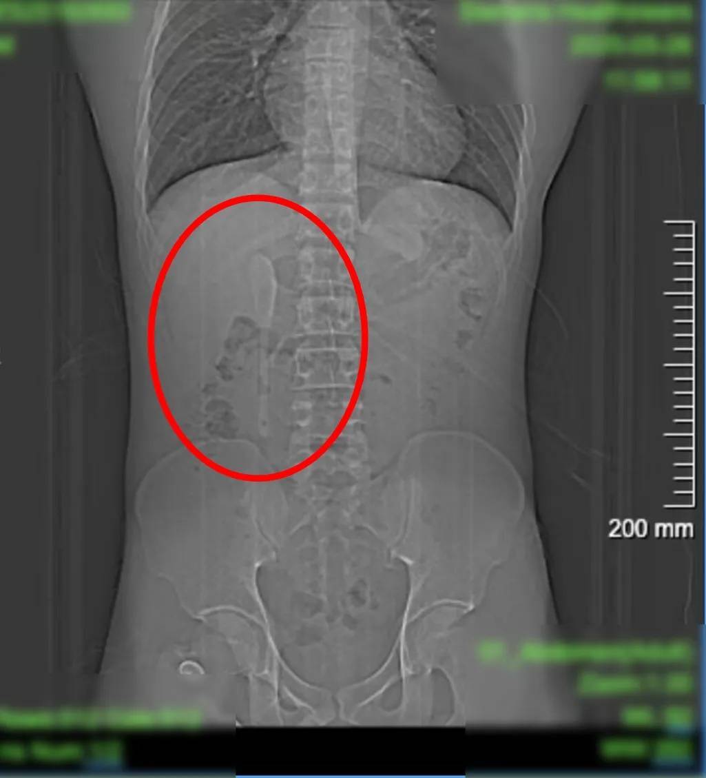 以为做梦，男子竟将15cm长咖啡勺“遗忘”腹中半年！