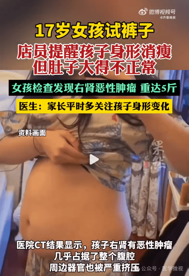 肚子变大别总以为是肥胖！17岁女孩因店员一句话救回一命