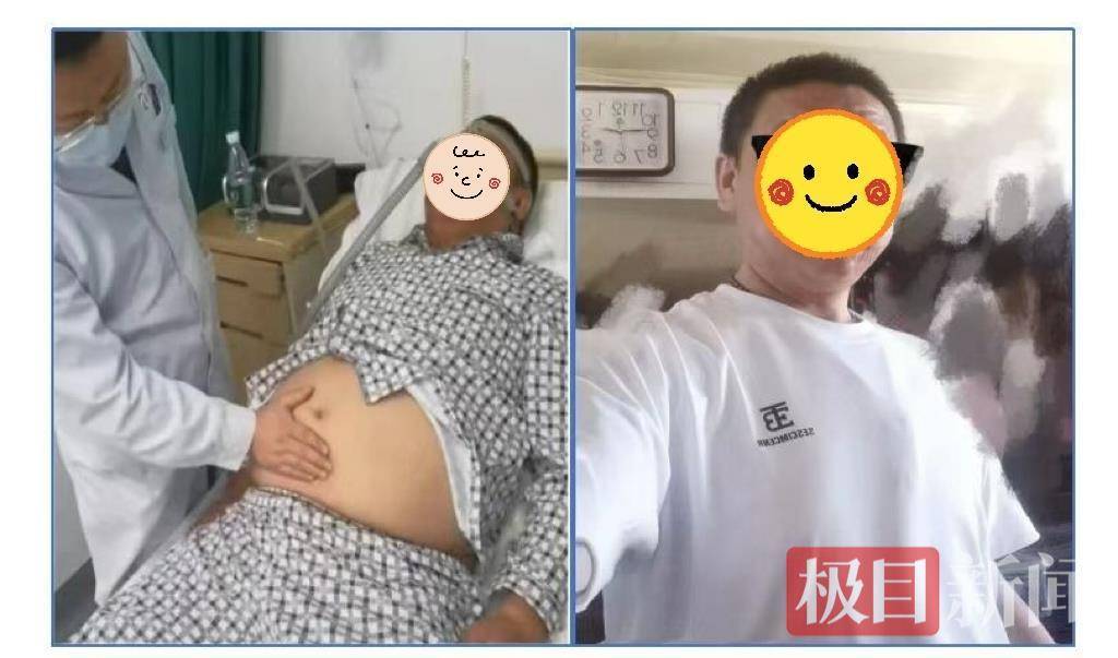 既减重还控糖，男子接受创新减重手术后3个月瘦了45斤