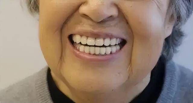 牙齿是糖尿病的“显示器”？医生提醒：牙齿若有3个异常，快检查