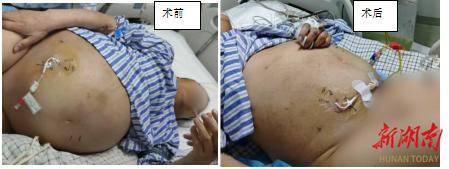 67岁老妇挺“孕肚”就诊，咋回事？