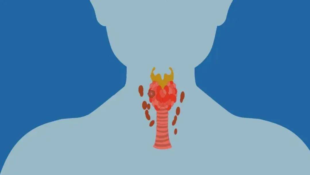 你一定想知道,甲状腺癌有哪些侵犯和转移?