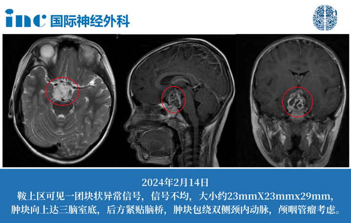 颅咽管瘤对视力和发育有影响吗？一文掌握颅咽管瘤关键预警信号！