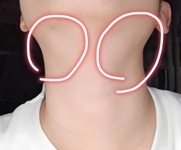 北京菌一生：从结节到癌症仅6年！听劝，三招掐灭甲状腺“基因炸弹”