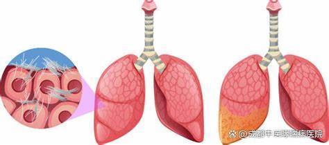 李邦良医生说：远离肺间质纤维化，这些要点你不能不知！