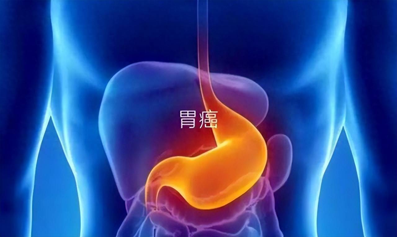 原创            早期胃癌治愈率高达90%以上，晚期不足10%，6类信号别忽视