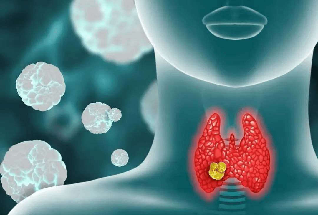 留住甲状腺！不开刀，超微创消融精准治疗甲状腺癌
