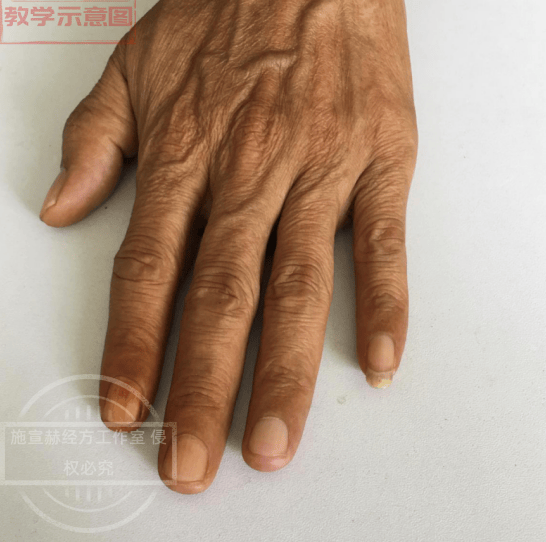 跟师施宣赫老师临证体悟：从脾论治脾胃失调的学术传承与临床实践