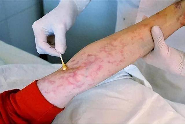 一旦感染艾滋病，多久能发觉？很多人误以为是皮肤病，千万别搞混