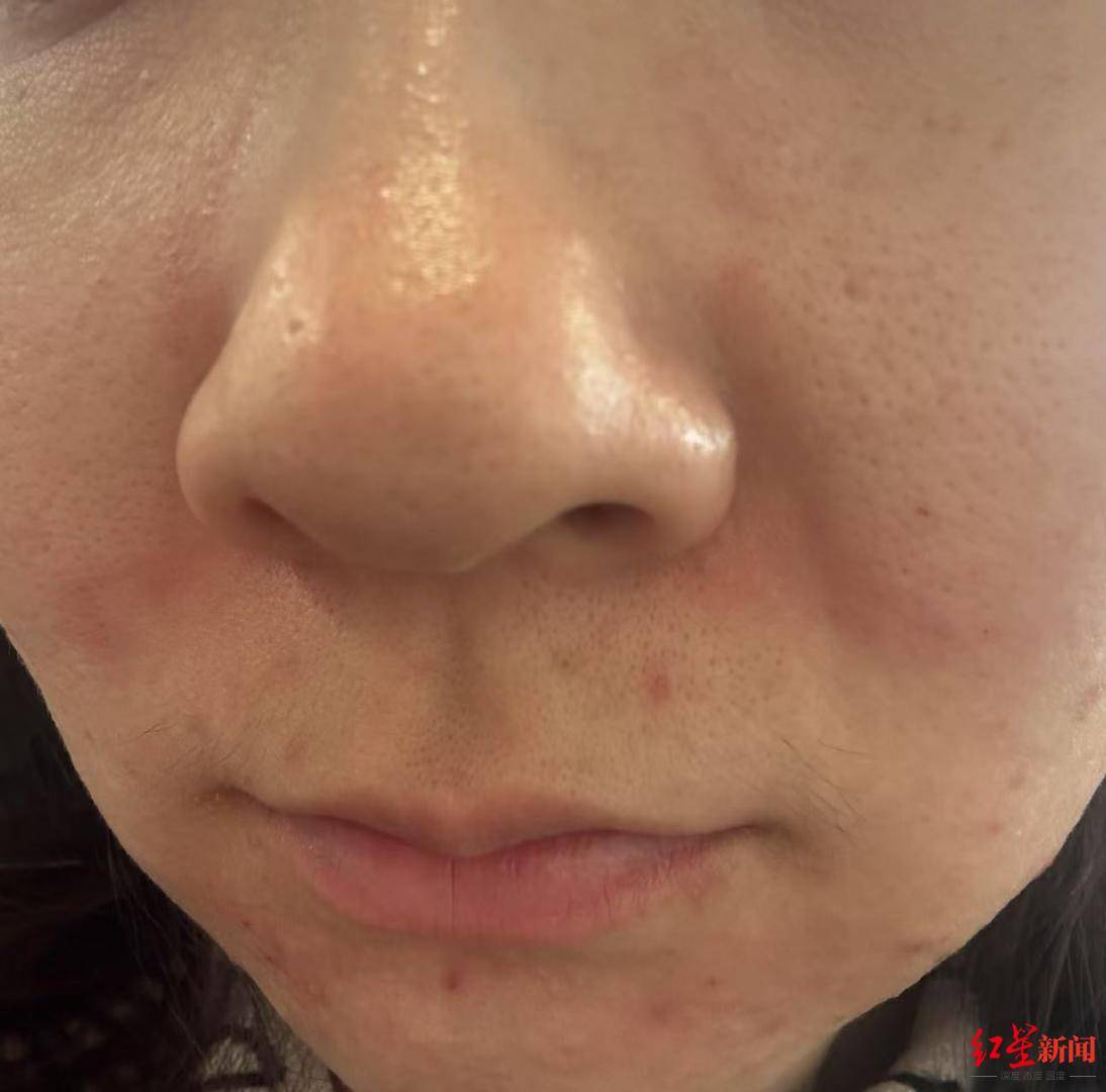 女子称打完“水光针”脸部红肿脱皮 涉事美容店：不是水光针，确无医美资质做的是生美