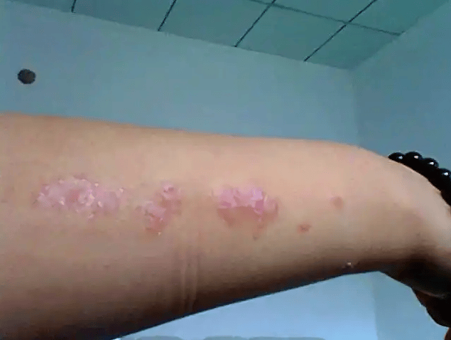 牛皮癣让我差点抑郁，直到遇见这套救命组合