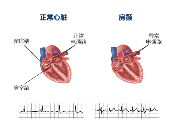 赵丹阳医生│高血压、喝酒、熬夜…你的习惯正在‘喂养’房颤！