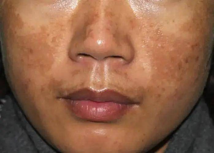 黄褐斑全攻略，别让黄褐斑成为您的困扰