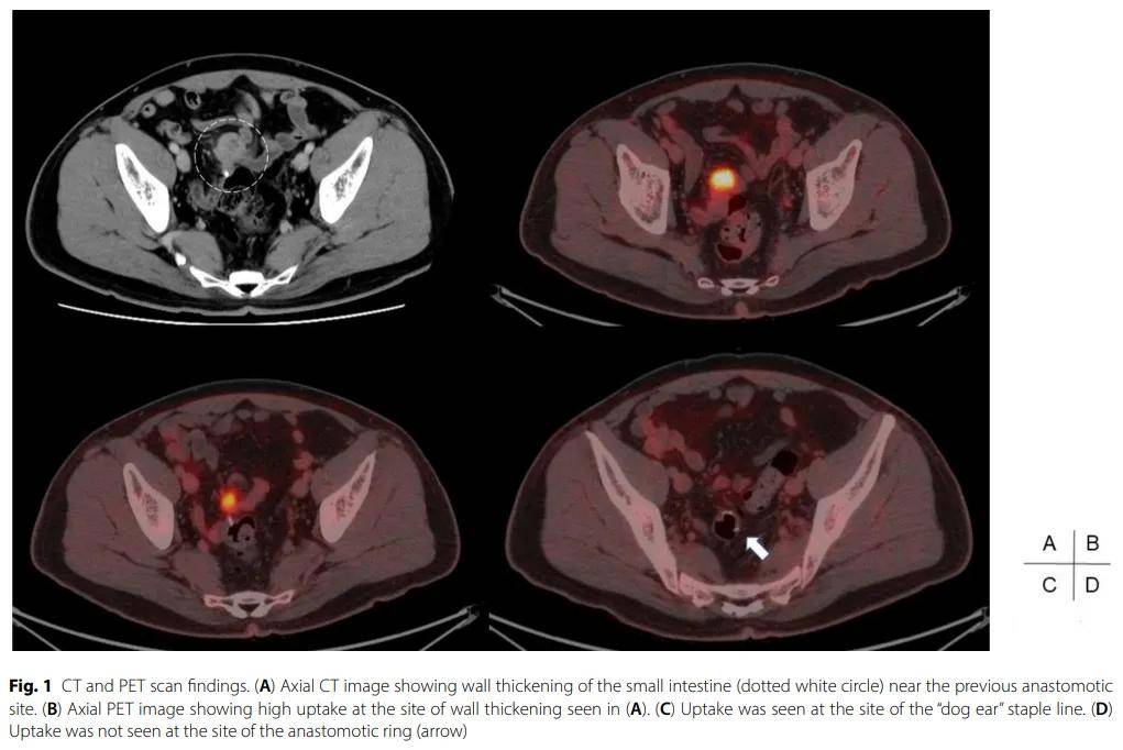 乙状结肠癌患者R0切除后进展，是局部复发还是原发小肠肿瘤？基因检测发现相同突变确认局部复发