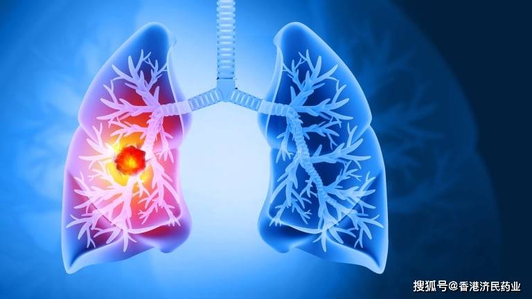 TROP2靶向疗法DATROWAY获批用于治疗EGFR突变型非小细胞肺癌
