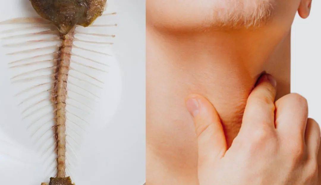 热议！拔一根鱼刺花了85元，嫌贵投诉医生，是医院赚大钱了吗？