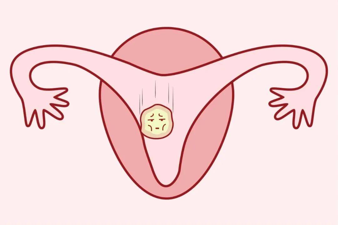 子宫内膜厚度一般是多少？厚度低于多少会影响女性生育力？