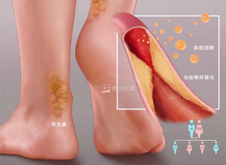 胆固醇高的人不能吃蛋黄？