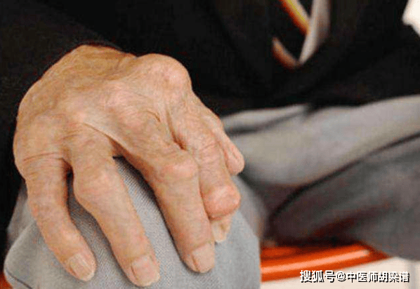关节疼，不一定是类风湿，真正的类风湿有4个典型表现！