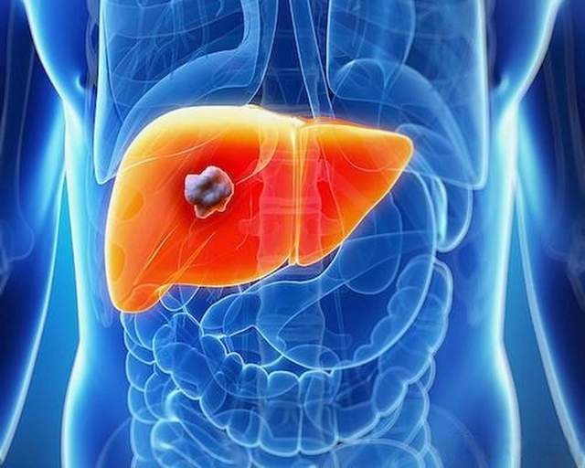 原创            早期肝癌五年生存率超70%，晚期不足15%！6类信号容易忽视