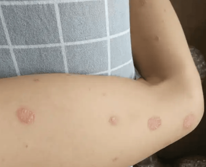 从全身鳞屑到光滑皮肤：安罗邦如何帮我战胜牛皮癣？