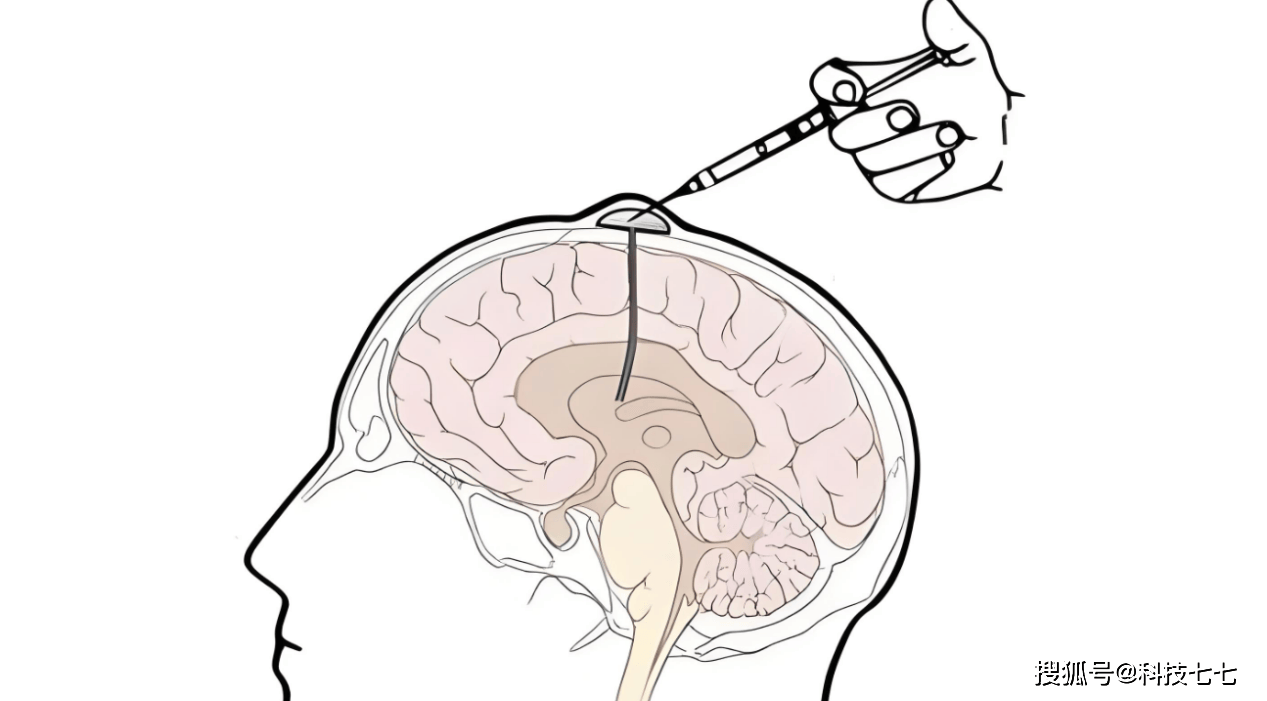 脂肪注入大脑？美国团队首创新型疗法，80%阿尔茨海默病患者恢复