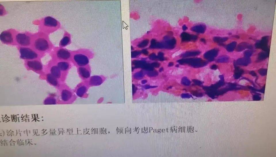 以为是湿疹，结果竟是癌！医生：很多人去错科室