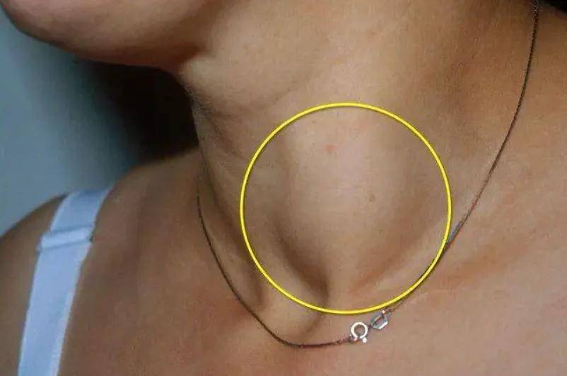 甲状腺癌术后复发的常见因素？如何科学降低复发率？