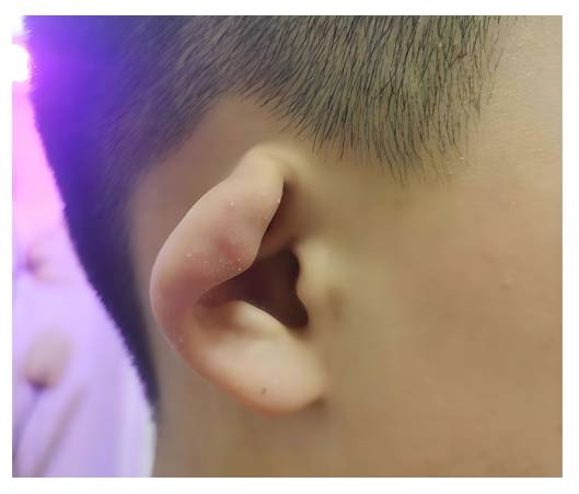 杯状耳整形的费用解析：价格区间与影响因素