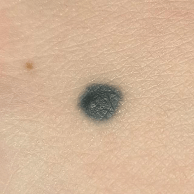 当罕见病遇上癌症……50岁浙江男子如何绝处逢生