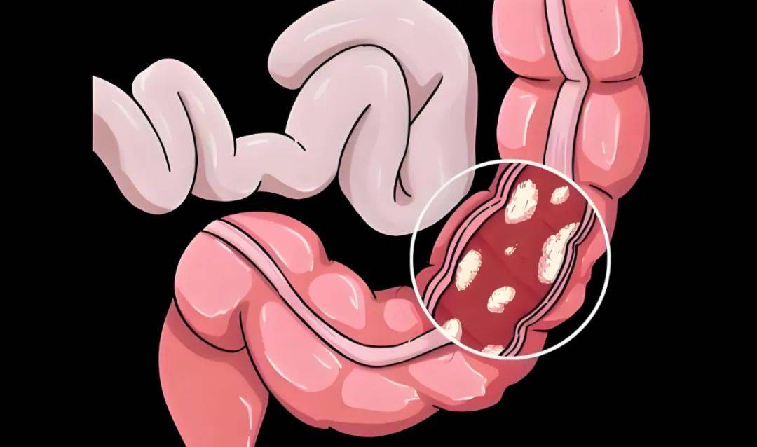 肠癌多半是拖出来的，别让肠癌“偷袭”！这4个身体信号千万别忽视！