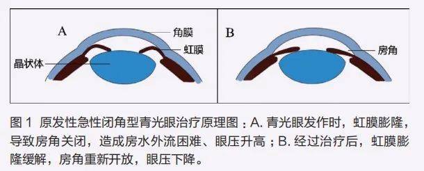 头痛，还要看“眼科”？
