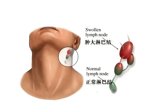 杨淑莲医生：淋巴瘤和淋巴癌的区别是什么