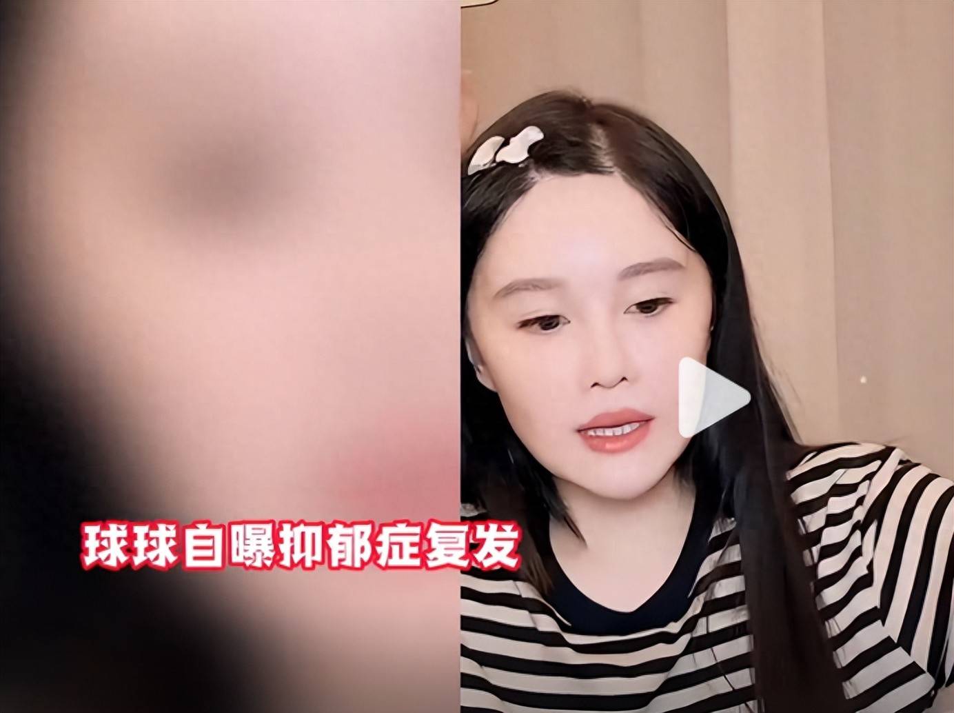 原创            赵本山女儿球球自爆抑郁复发，曾宣布生娃后退网，不差直播那点钱