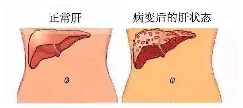 肝不好人废一半！艾灸养肝排毒，让你更年轻!