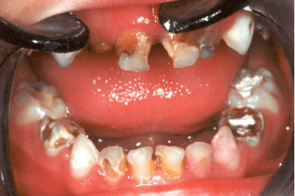 爱吃糖、喝饮料、刷牙马虎？娃的乳牙蛀了真不能不管！