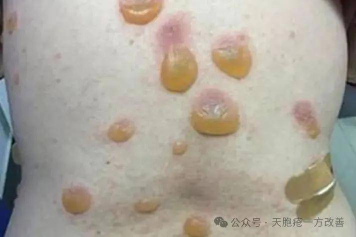 肌肤板硬失柔润？健脾祛湿通经络，硬皮渐软复生机