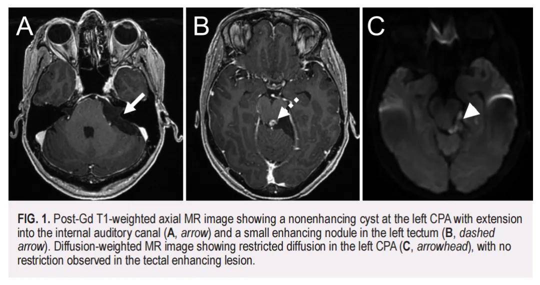 颅内表皮样囊肿术后转化为鳞状细胞癌，NGS探索原因之余检出TMB-H获益免疫联合治疗