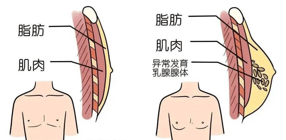 肝脏功能异常与男性乳腺发育：隐秘的关联
