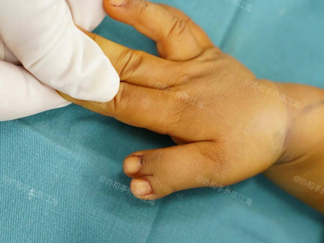 原创            多指│案例44《妈妈：我的女儿和别人并没有差别！》