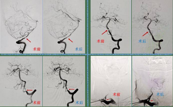【朝医新闻】神经外科完成多例经桡动脉脑血管病介入治疗