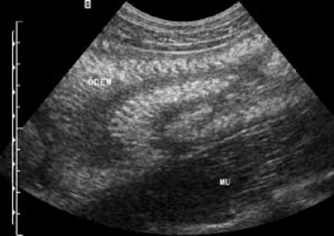 您听说过“白肠”吗？- White bowel