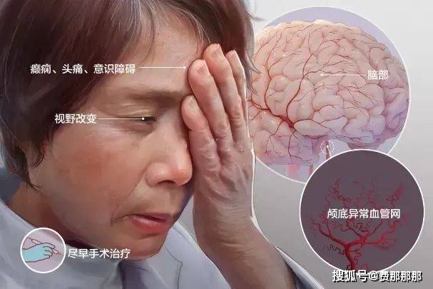 诊断烟雾病后多久需要手术？