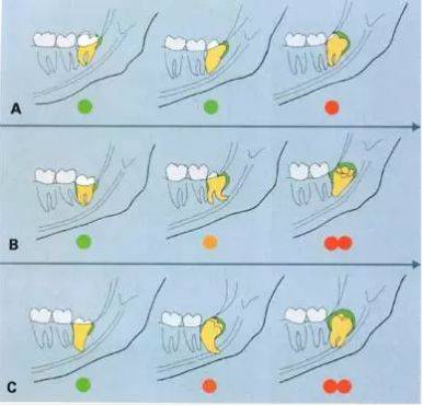 拔牙技巧图解，超实用！