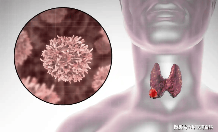南昌第五医院甲状腺科江辉主任：甲减患者必补4类营养素！